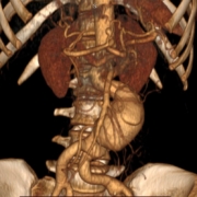 Ruptured abdominal aortic aneurysm
