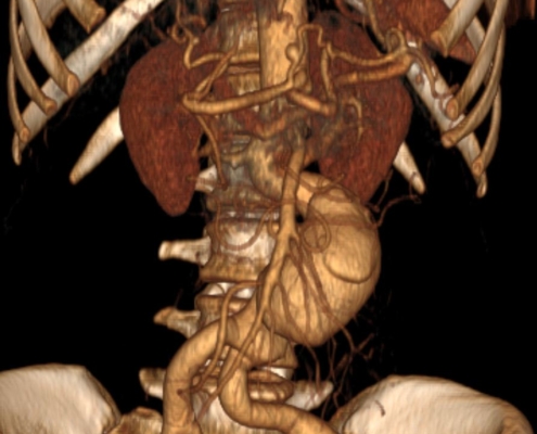 Ruptured abdominal aortic aneurysm
