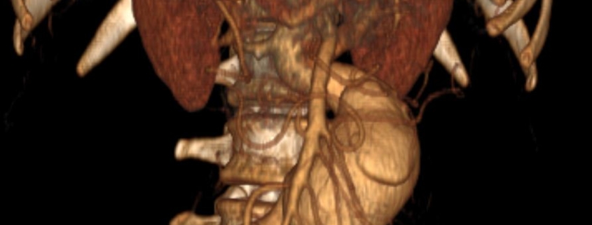 Ruptured abdominal aortic aneurysm