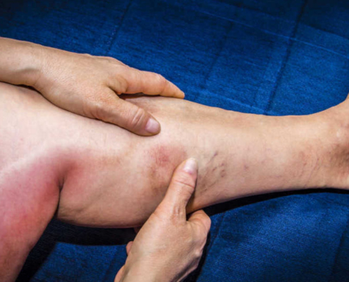 Deep Vein Thrombosis