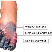Foot Gangrene