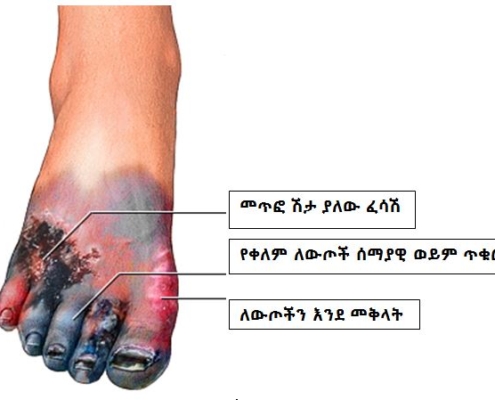 Foot Gangrene