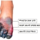 Foot Gangrene